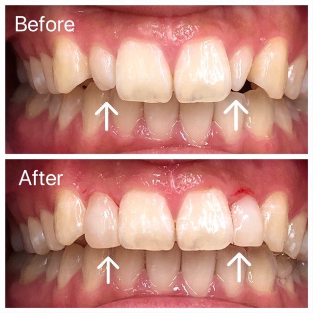 プチ矯正 写真