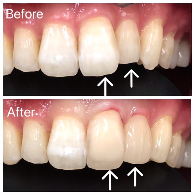 セラミック矯正 セラミック 写真