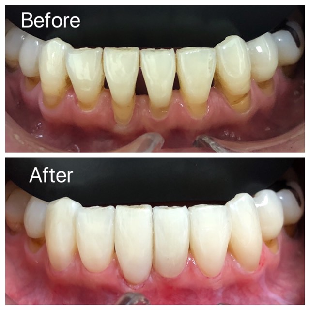 セラミック治療 写真