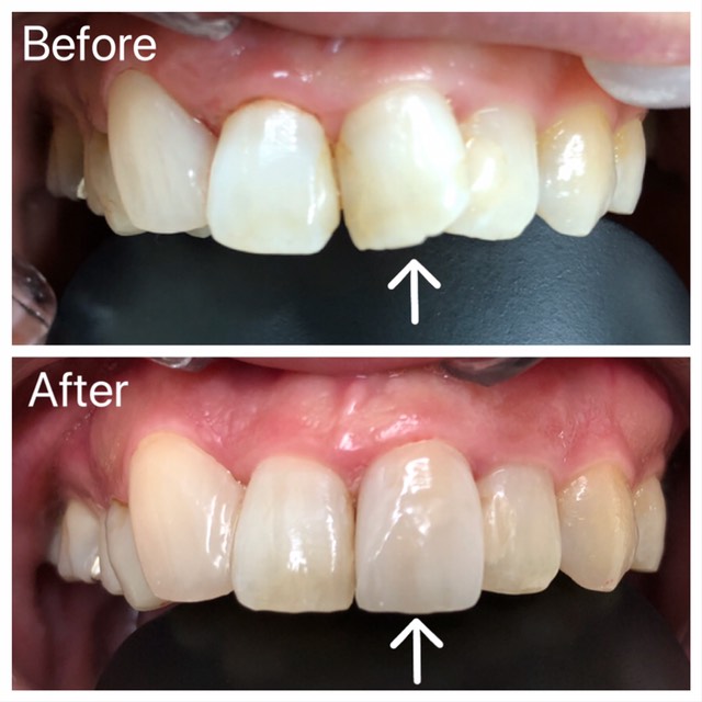 セラミック矯正 写真